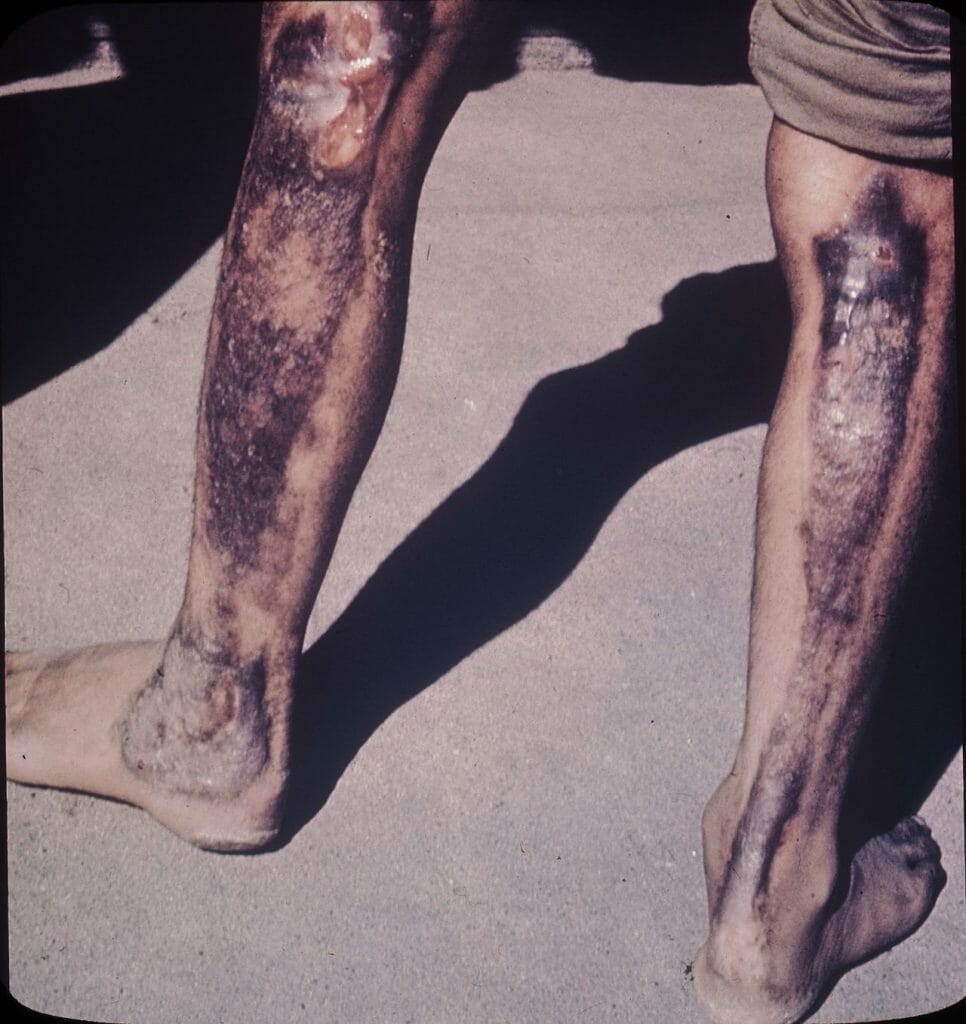 <span style="color: #ffffff;">Hiroshima patients - burns due to atomic radiation of legs</span>